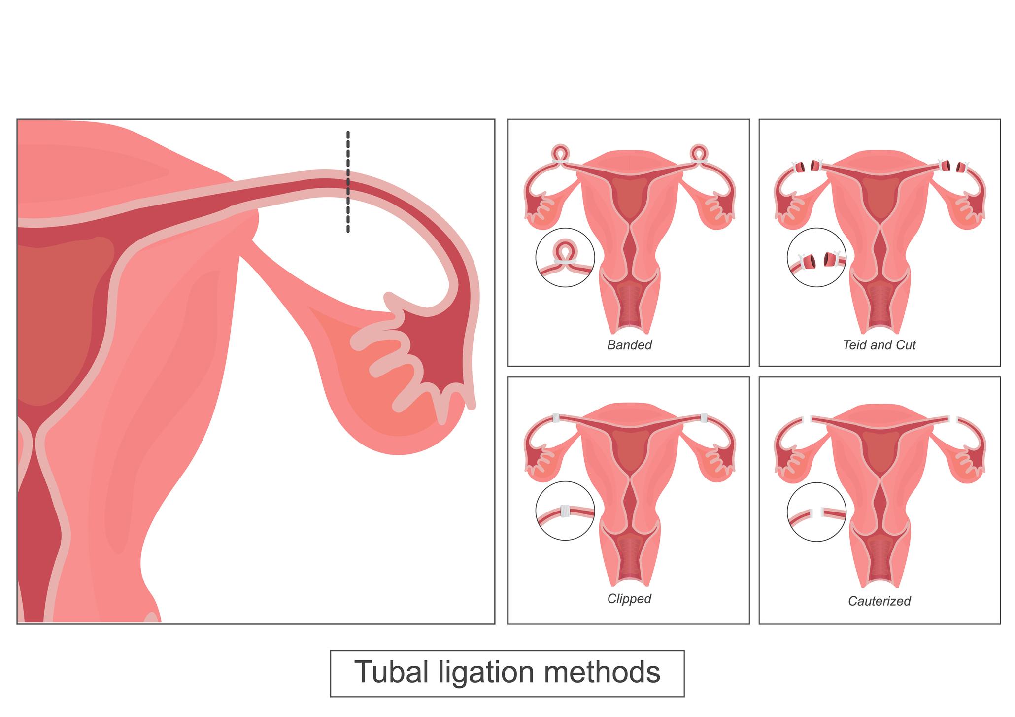 Laparoscopic Tubectomy in Pune